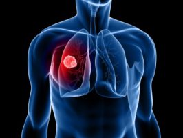 סיכון מוגבר לסרטן ריאות במטופלים לאחר זיהום בשחפת (Clin Infect Dis)