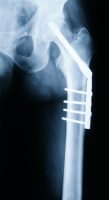 ניתוח בעזרת רובוט להחלפה מלאה של מפרק הירך עשוי לקצר משך אשפוז (J Arthroplasty)