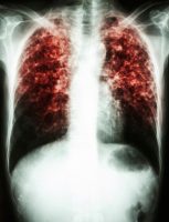 מדד חדש עשוי לסייע בחיזוי הסיכון לתמותה בחולים עם שחפת ריאתית (Chest)