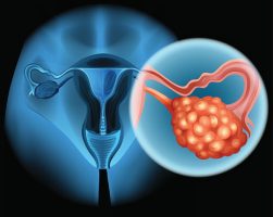 המהלך הטבעי והפוטנציאל הממאיר של ציסטות פשוטות בשחלות (Menopause)