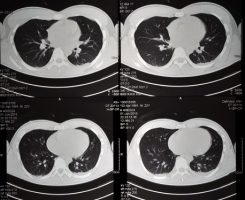 בדיקת CT עשויה לסייע בחיזוי התקדמות COPD (מתוך Chest)