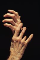 תוצאות חיוביות לטיפול שמרני באוסטיאוארתריטיס של שורש כף היד (J Bone Joint Surg)
