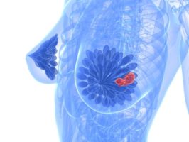 סרקופניה מלווה בסיכון מוגבר להפסקת טיפול הורמונאלי בנשים עם סרטן שד (מתוך אתר Researchsquare)