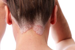 עדויות חדשות בנוגע לטיפול ביולוגי בפסוריאזיס (JAMA Dermatology)