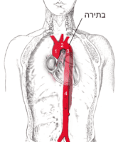 איזו מפרצת הרגה את העיתונאי גרנט וול ? מאמר אורח מאת דר' משה חלק