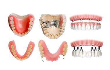 שיקום הפה במקרה של אובדן שיניים - מאמר אורח מאת ד