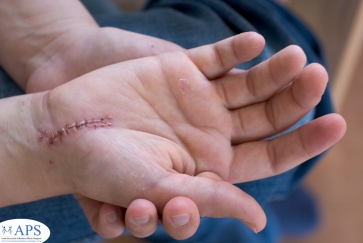 ניתוח כף יד טראומה HAND SURGERY