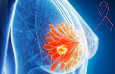 גורמי סיכון להתפתחות סרטן שד שני בתוך חמש שנים בנשים עם היסטוריה של סרטן שד (J Natl Cancer Inst)