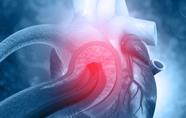 פרוצדורת TAVR בשלב מוקדם עדיפה על מעקב בלבד בחולים אסימפטומטיים עם היצרות חמורה של מסתם הוותין (N Engl J Med)