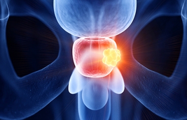 גורמי סיכון לסיבוכים לאחר אורטרוסוקפיה (Urology)